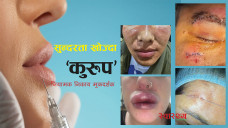 छाला उपचारमा मनपरी: विज्ञ भन्दै ठग्दै, समस्या झन् बल्झाउँदै